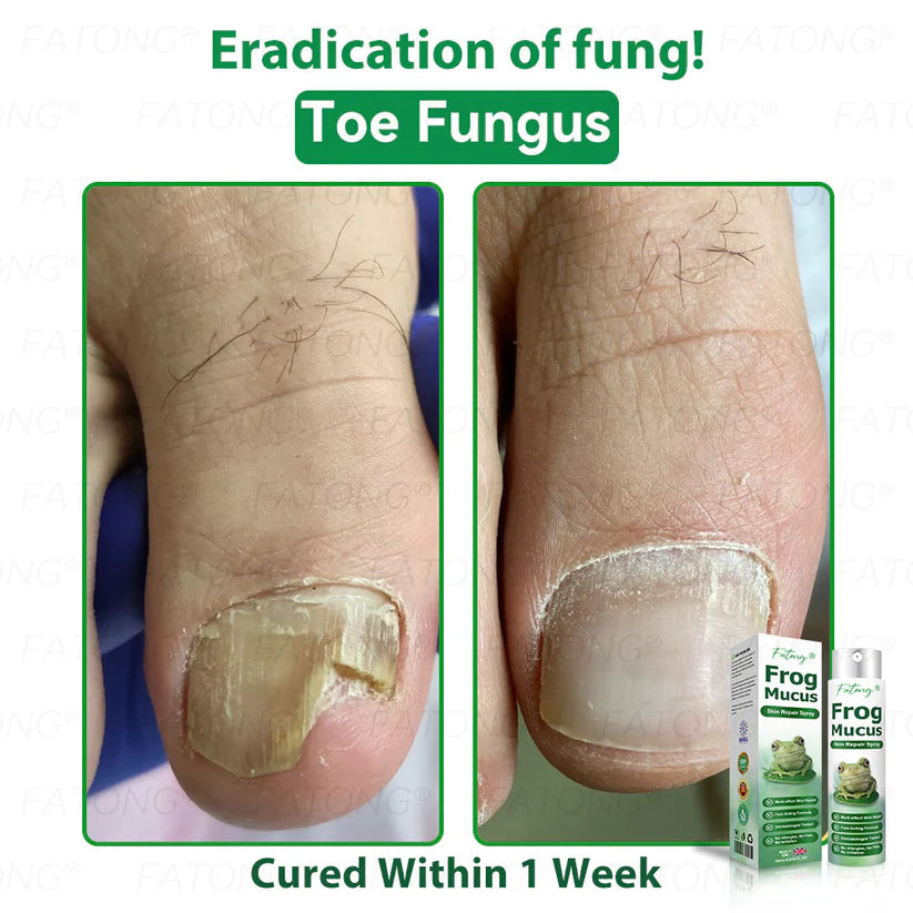 ๐ธ Qooesยฎ Frog Mucus Skin Repair Spray โ Repair, Soothe & Restore Your Skin Instantly