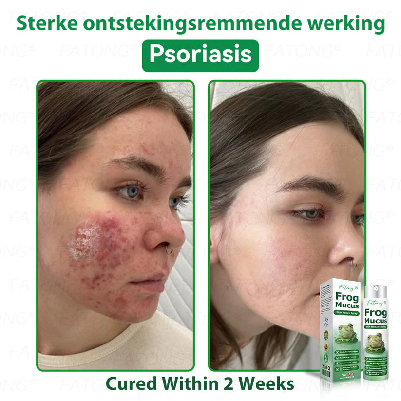 ๐ธ Qooesยฎ Frog Mucus Skin Repair Spray โ Repair, Soothe & Restore Your Skin Instantly