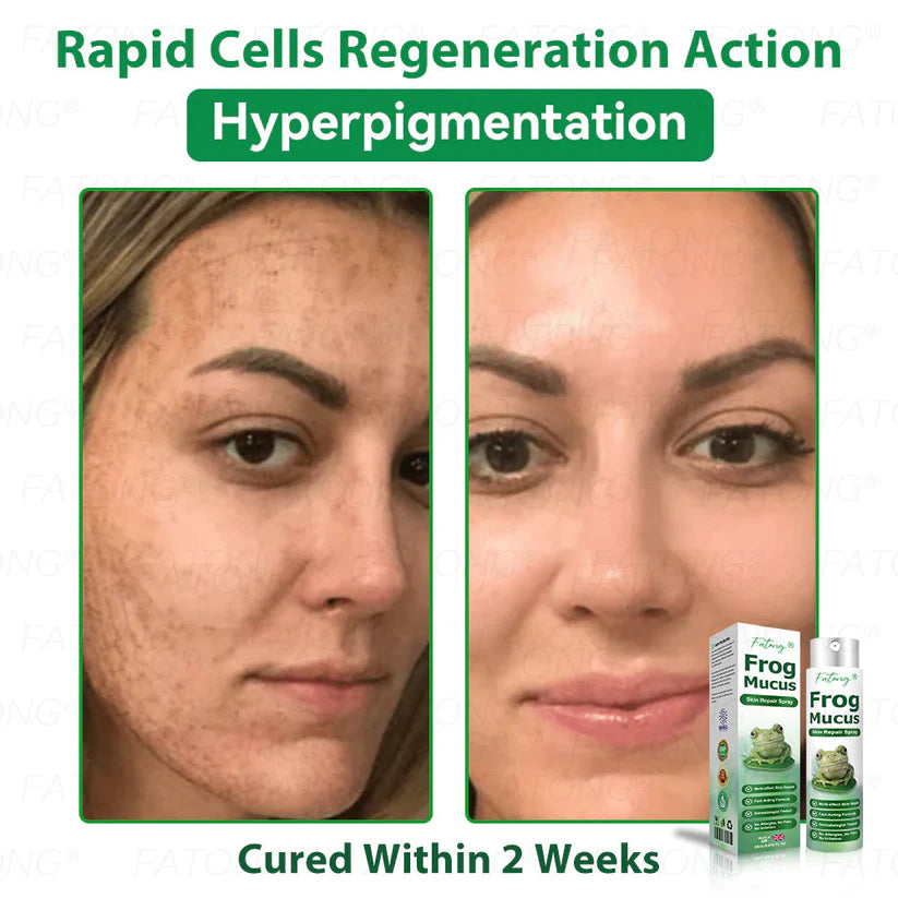 ๐ธ Qooesยฎ Frog Mucus Skin Repair Spray โ Repair, Soothe & Restore Your Skin Instantly