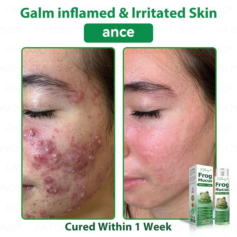 ๐ธ Qooesยฎ Frog Mucus Skin Repair Spray โ Repair, Soothe & Restore Your Skin Instantly