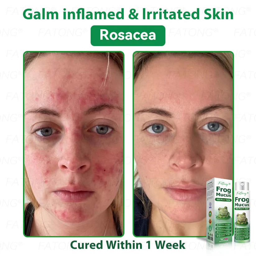 ๐ธ Qooesยฎ Frog Mucus Skin Repair Spray โ Repair, Soothe & Restore Your Skin Instantly