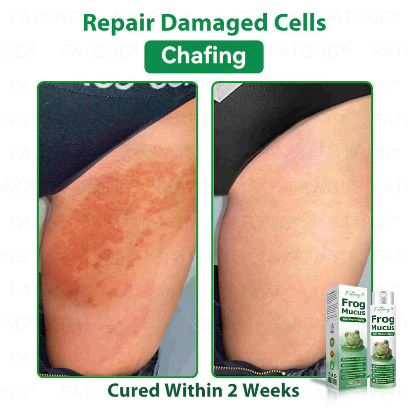 ๐ธ Qooesยฎ Frog Mucus Skin Repair Spray โ Repair, Soothe & Restore Your Skin Instantly