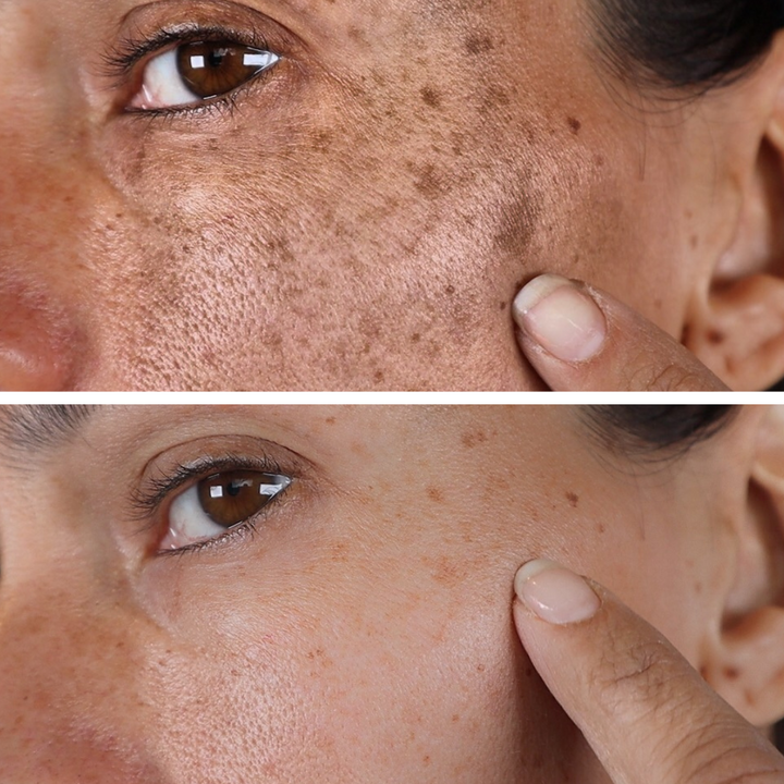 🌟 Glow Up Fast with Qooes® – Dark Spot Corrector & Anti-Aging Renewal Cream🌟